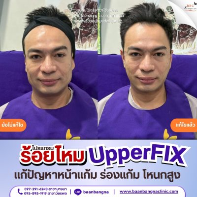 upperfix