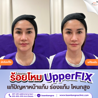 upperfix