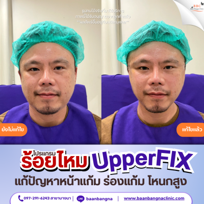 upperfix