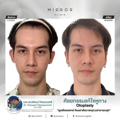 Review EARS
