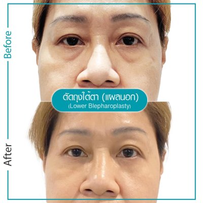 รีวิวตา