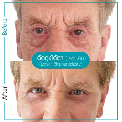 รีวิวตา