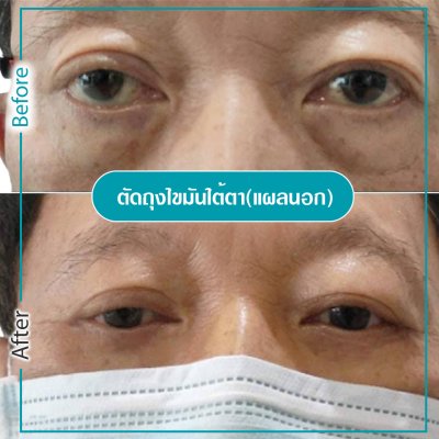 รีวิวตา