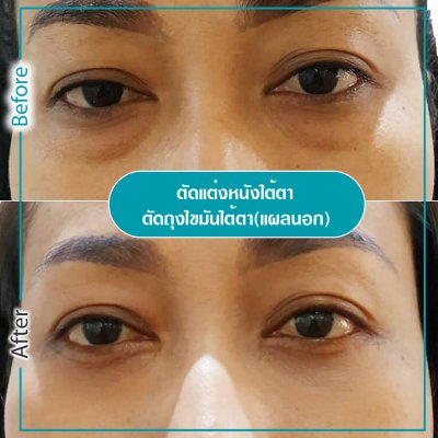 รีวิวตา