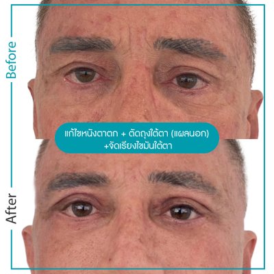 รีวิวตา