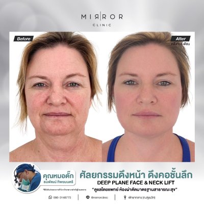 Face Lift / Neck Lift