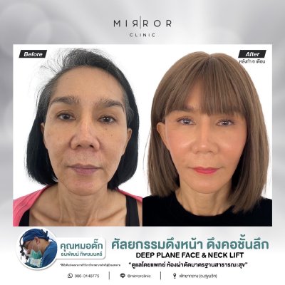 Face Lift / Neck Lift