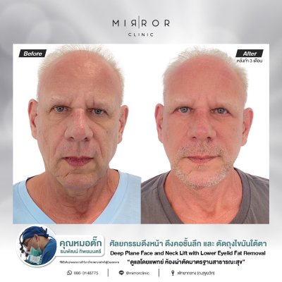 Face Lift / Neck Lift