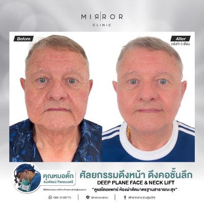 Face Lift / Neck Lift