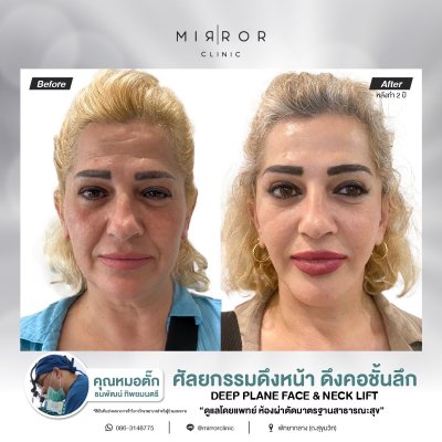 Face Lift / Neck Lift