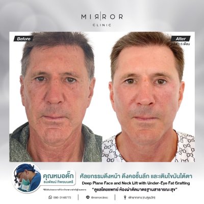 Face Lift / Neck Lift