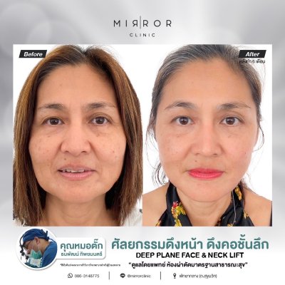 Face Lift / Neck Lift