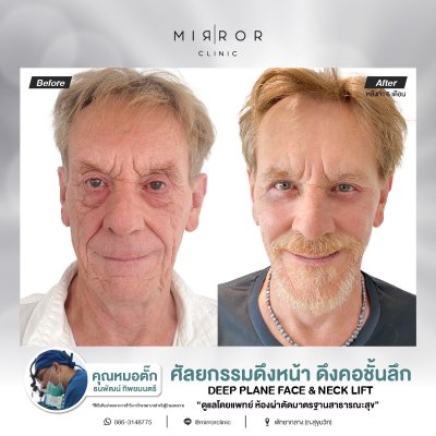 Face Lift / Neck Lift