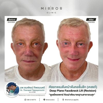 Face Lift / Neck Lift