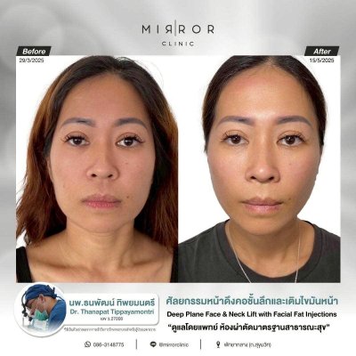 Face Lift / Neck Lift