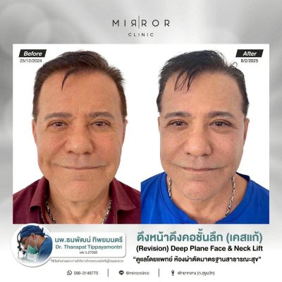 รีวิวดึงหน้าดึงคอ