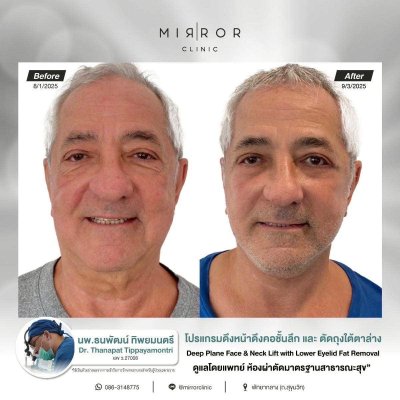 รีวิวดึงหน้าดึงคอ