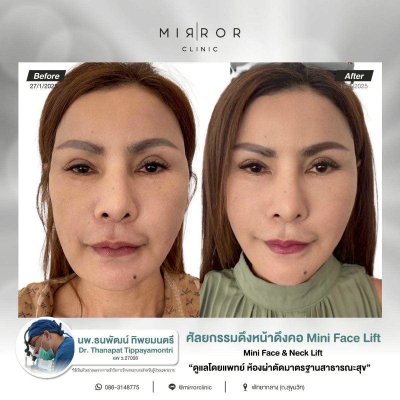 รีวิวดึงหน้าดึงคอ