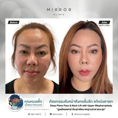 รีวิวดึงหน้าดึงคอ