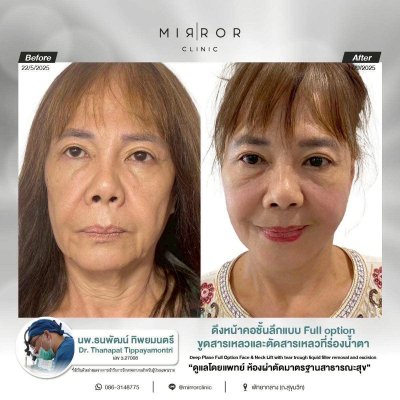 Face Lift / Neck Lift