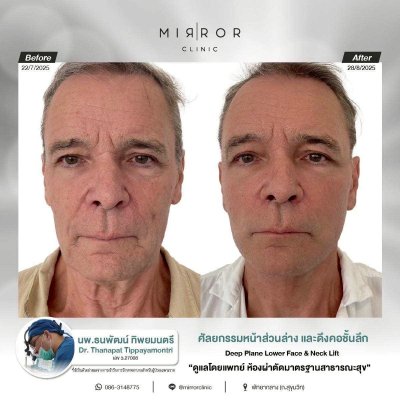 Face Lift / Neck Lift