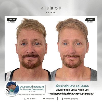 Face Lift / Neck Lift