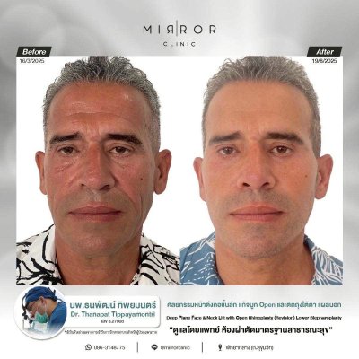 Face Lift / Neck Lift