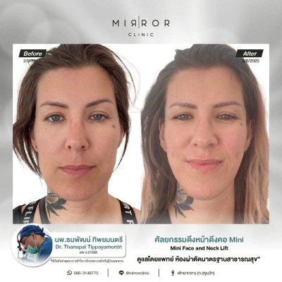 Face Lift / Neck Lift