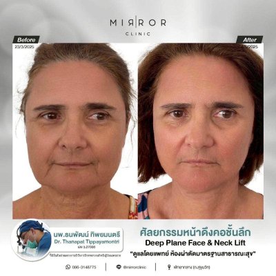 Face Lift / Neck Lift