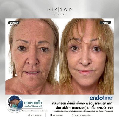 Face Lift / Neck Lift