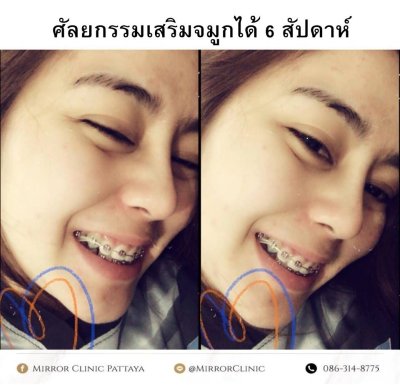 รีวิวเสริมจมูก