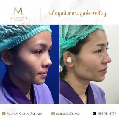 รีวิวเสริมจมูก