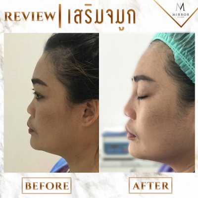 รีวิวเสริมจมูก
