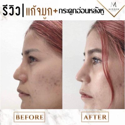 รีวิวเสริมจมูก