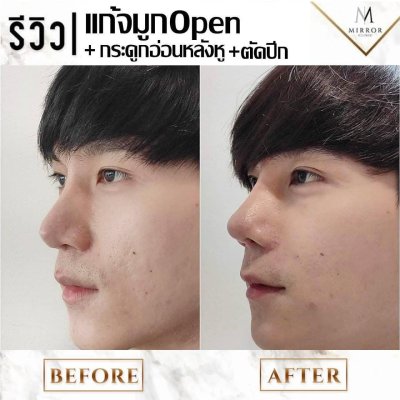 รีวิวเสริมจมูก