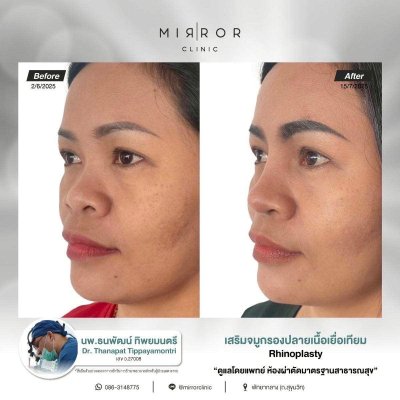 รีวิวเสริมจมูก