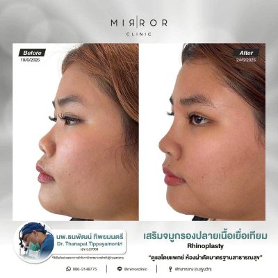 รีวิวเสริมจมูก