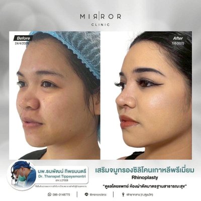 รีวิวเสริมจมูก