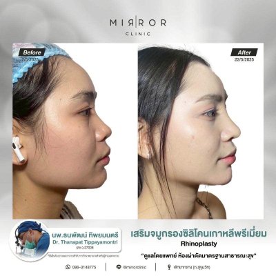 รีวิวเสริมจมูก