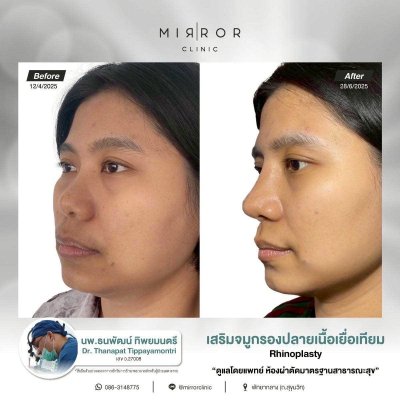 รีวิวเสริมจมูก