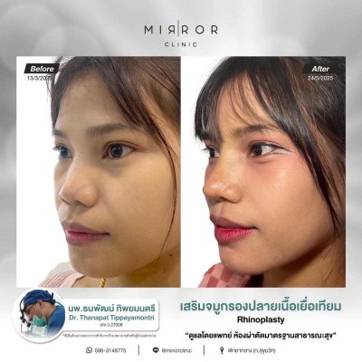 รีวิวเสริมจมูก