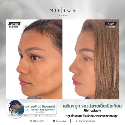 รีวิวเสริมจมูก