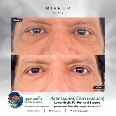 Upper / Lower Eyelids