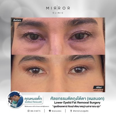 Upper / Lower Eyelids