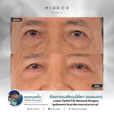 Upper / Lower Eyelids