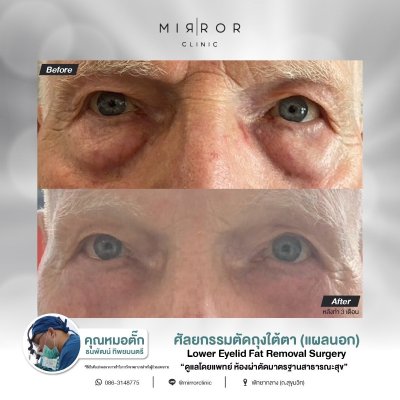 Upper / Lower Eyelids