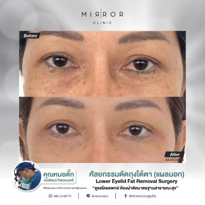 Upper / Lower Eyelids