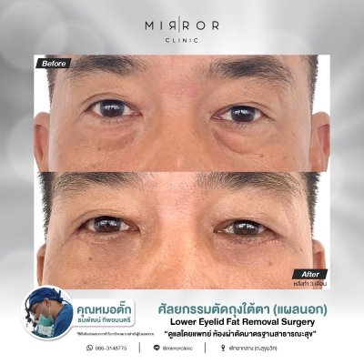 Upper / Lower Eyelids