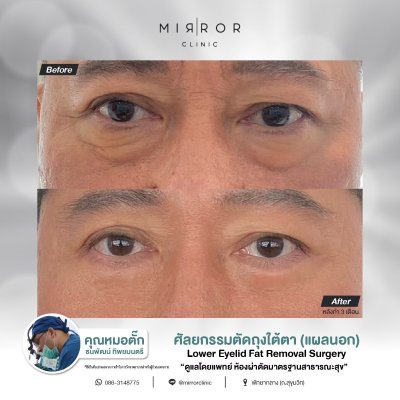 Upper / Lower Eyelids