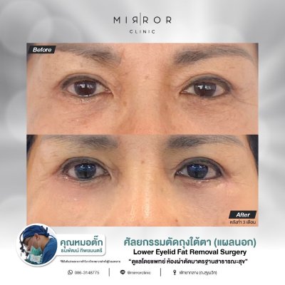 Upper / Lower Eyelids